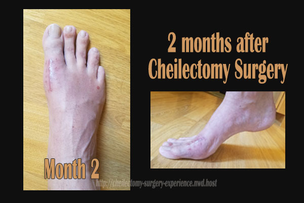two months recovery after cheilectomy surgery