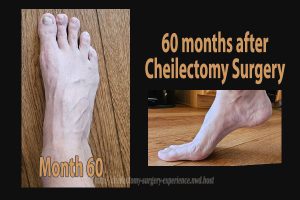 Year 5 (post-cheilectomy surgery) - Cheilectomy Surgery Experience